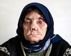 آمار ترسناک مبتلایان جذام در ایران | ۳ نشانه‌ اصلی بیماری