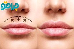 هزینه عمل جراحی سانترال لب در تهران