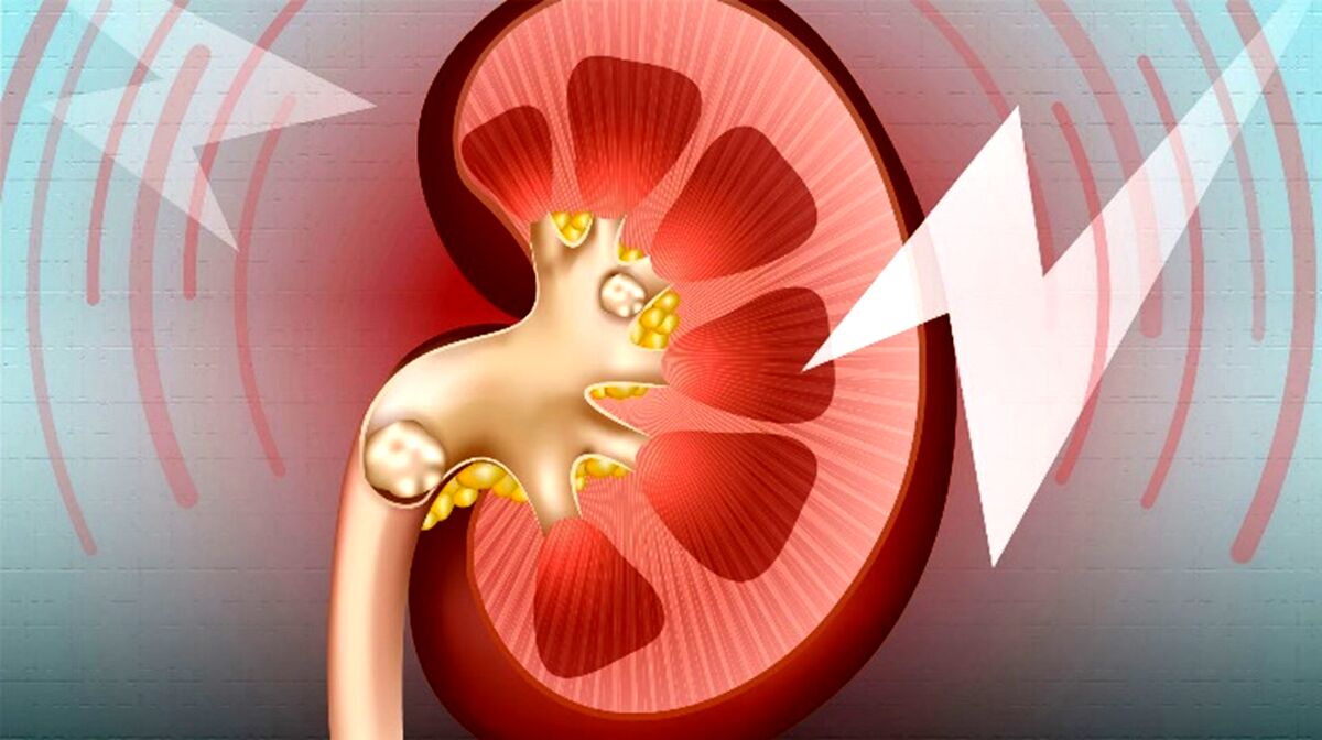 علت سنگ کلیه چیست و چه زمان به درمان پزشکی نیاز دارد؟