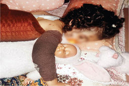 عکس تلخ از حمله خونین سگ‌های ولگرد به دختر ۳ساله کرجی 