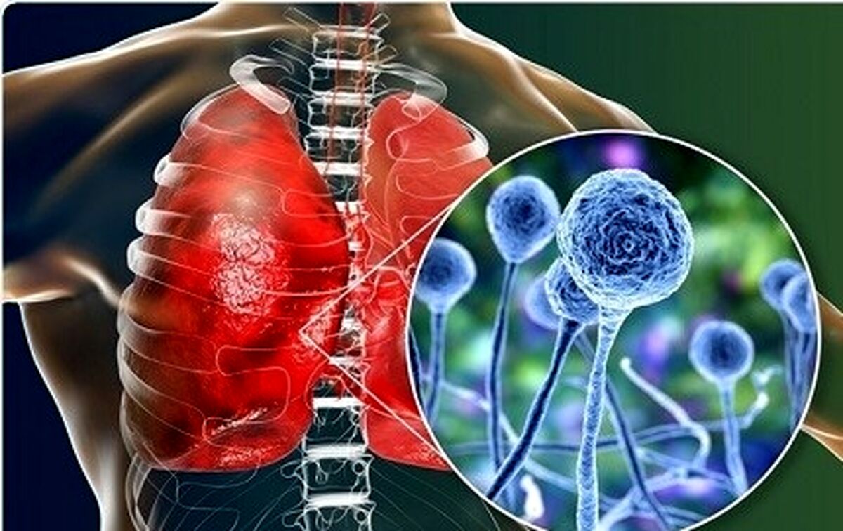  بیماری قارچ سیاه چیست؟+جزئیات بیشتر را بخوانید 
