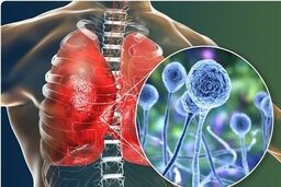  بیماری قارچ سیاه چیست؟+جزئیات بیشتر را بخوانید 