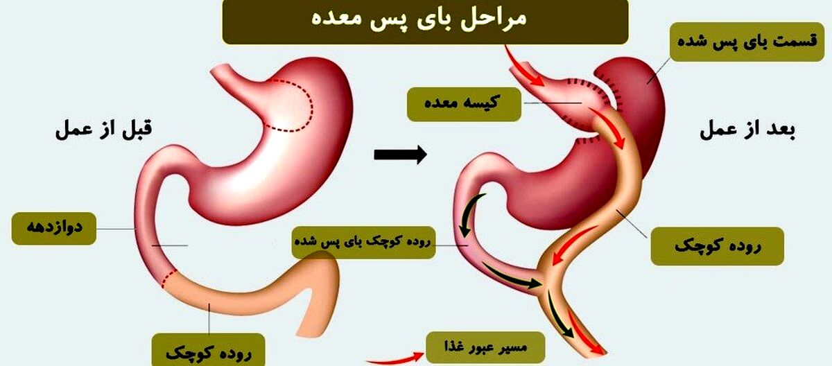 بای پس معده چیست؟
