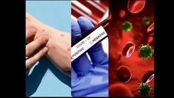اتفاق دردناک برای این مرد ایتالیایی | همزمان دچار کرونا، آبله میمونی و ایدز شد!