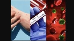 اتفاق دردناک برای این مرد ایتالیایی | همزمان دچار کرونا، آبله میمونی و ایدز شد!