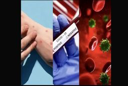 اتفاق دردناک برای این مرد ایتالیایی | همزمان دچار کرونا، آبله میمونی و ایدز شد!