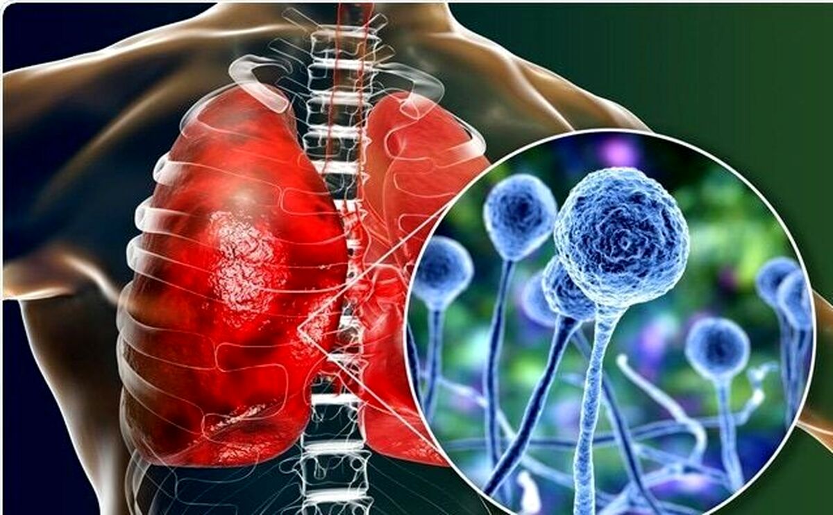  بیماران کرونایی مراقب قارچ سیاه باشند!