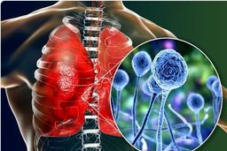  بیماران کرونایی مراقب قارچ سیاه باشند!