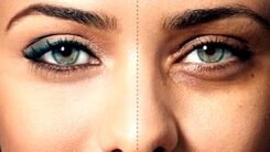 چگونه سیاهی دور چشم را ازبین ببریم؟