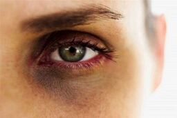 روش‌های خانگی برای نابودی سیاهی دور چشم!
