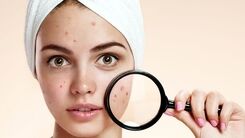 چگونه جوش های صورت را از بین ببریم؟