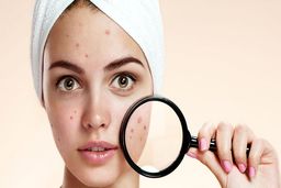 چگونه جوش های صورت را از بین ببریم؟