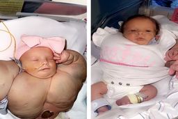 تولد نوزاد عجیب | تصاویری از یک نوزاد با دست و بالاتنه‌ای بزرگ