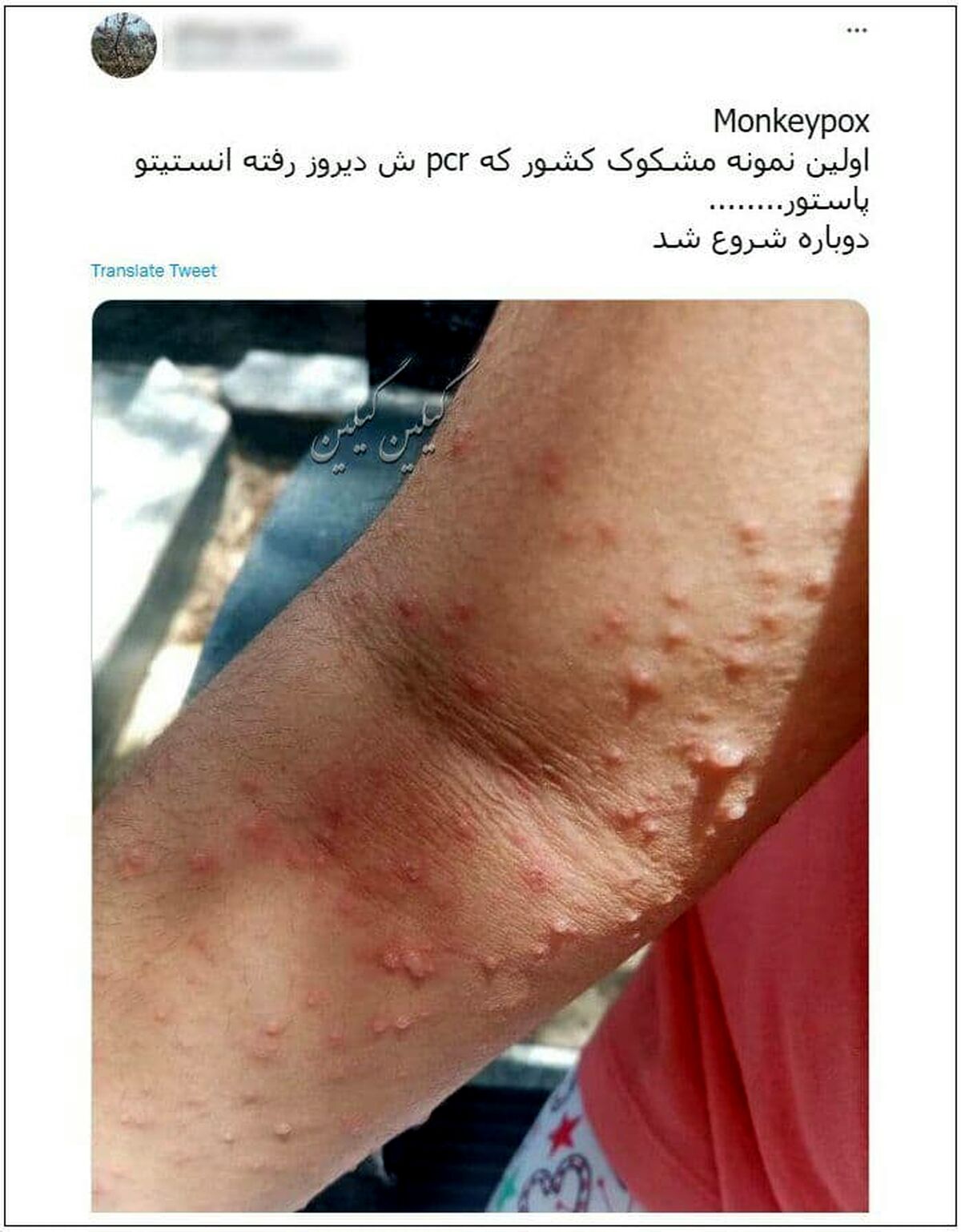 آبله میمونی به ایران رسید؟ | انتشار تصویر یک کودک ایرانی مشکوک به آبله میمونی