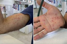  آخرین وضعیت بیماری آبله میمونی | توصیه مهم به مسافران