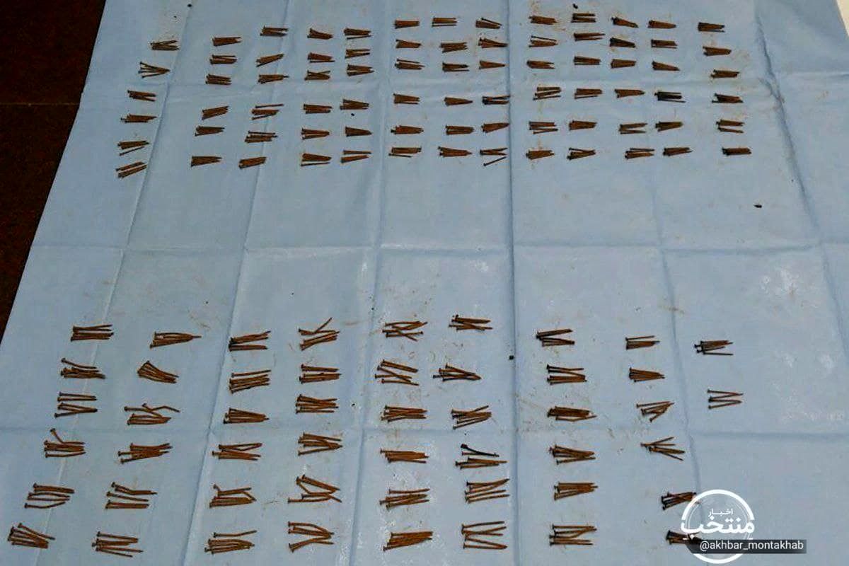 جراحی ۶۰۰ میخ فلزی از شکم مرد هندی خارج کرد+عکس