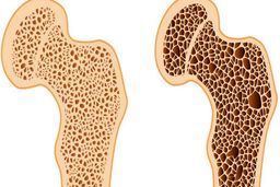 نکات ورزشی مهم برای افرادی که پوکی استخوان دارند | چه ورزش هایی باید انجام داد ؟