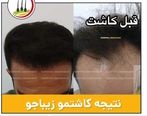 کاشت مو با تکنیک های جدید