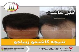 کاشت مو با تکنیک های جدید