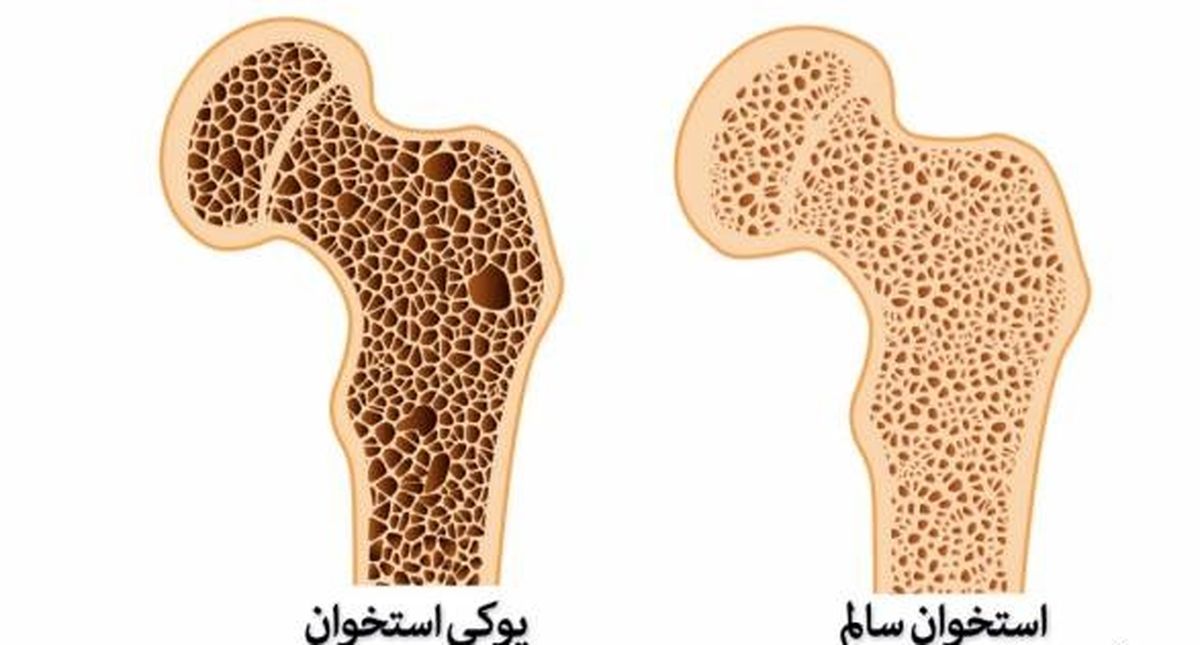 برای پوکی استخوان چی بخوریم؟