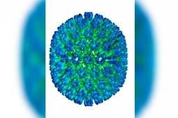 کشف جدید درباره بیماری «ام اس»/ عامل ویروسی شناسایی شد