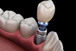 مراقبت بعد از ایمپلنت دندان: تغذیه، کاهش درد و بالا بردن شانس موفقیت آن