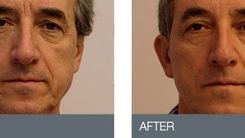 معرفی لیفت با نخ