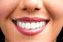 دندانپزشکی زیبایی و تاثیرات ان در طرح لبخند