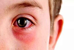 تعطیلی یک هفته ای مدارس به دلیل شیوع عفونت چشم |  راه های سرایت این بیماری خطرناک
