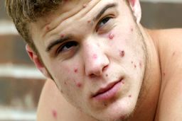 آبله میمون چیست و چه علائمی دارد ؟