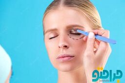 هزینه جراحی بلفاروپلاستی در سال 1401 چقدر است ؟