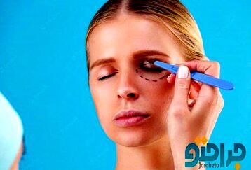 هزینه جراحی بلفاروپلاستی در سال 1401 چقدر است ؟