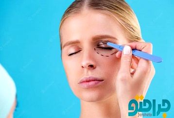 هزینه جراحی بلفاروپلاستی در سال 1401 چقدر است ؟
